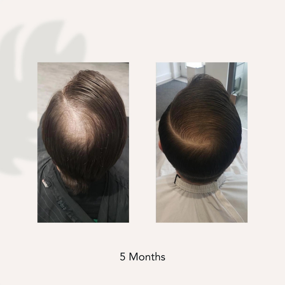 Recover - Traitement shampooing homme-Dégarnissage et perte de cheveux||Hair Loss & Thinning-ACTIIV-Gisèle produits de beauté